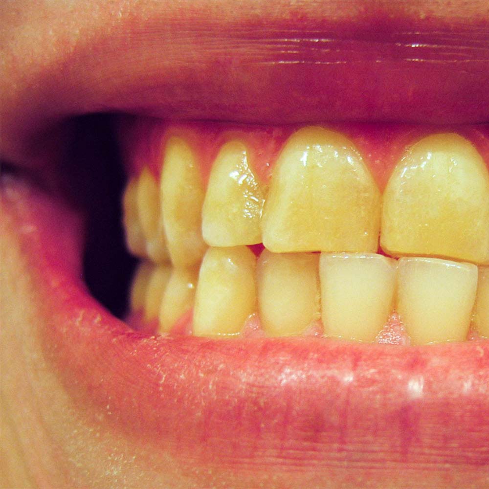 Close up of yellow teeth