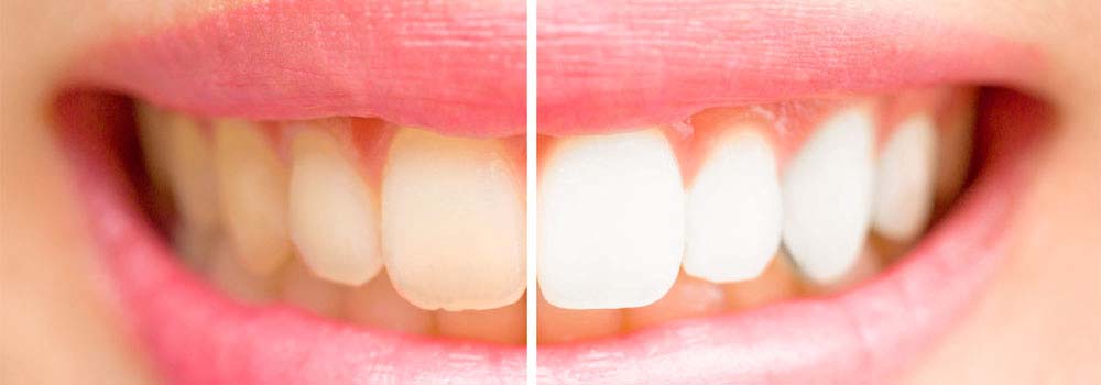Yellow teeth: what causes them & do you need to worry about it? 12