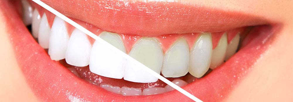 Yellow teeth: what causes them & do you need to worry about it? 10