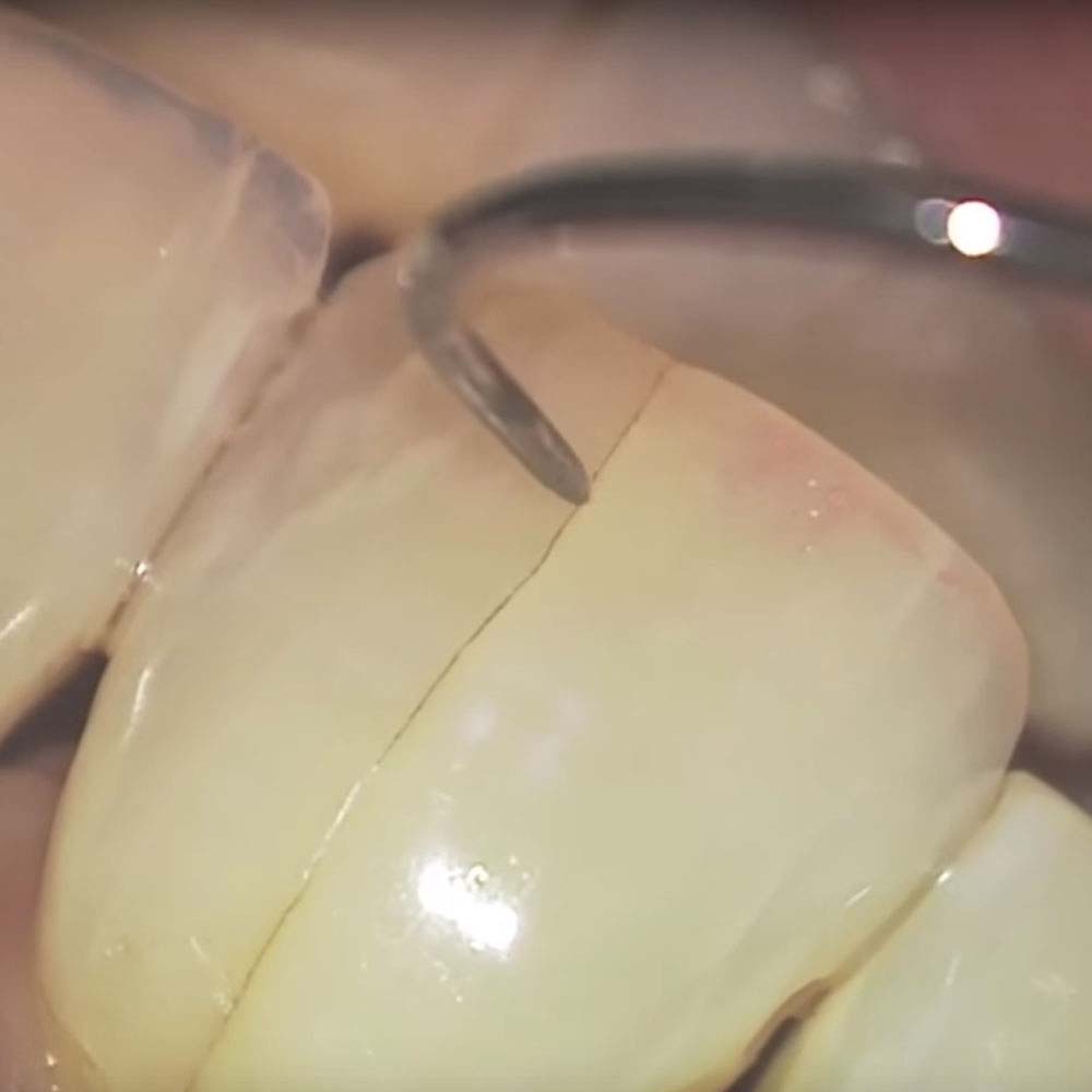 Tooth repair: how to fix a chipped, cracked or broken tooth 20