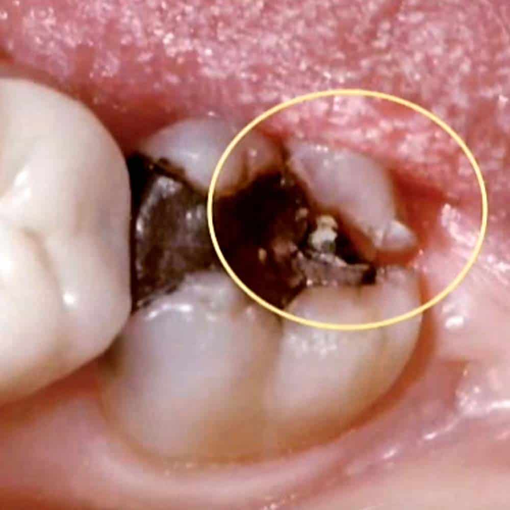 Tooth repair: how to fix a chipped, cracked or broken tooth 7