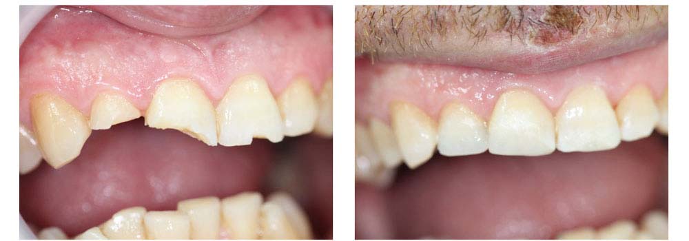 Broken tooth repair before and after