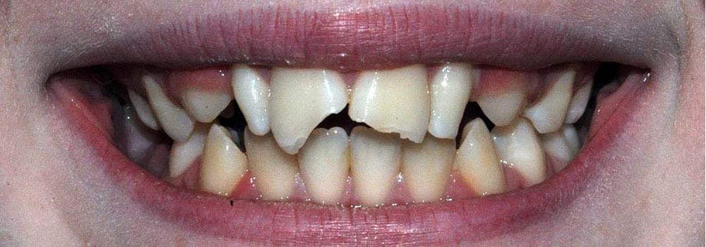 Photo of broken teeth