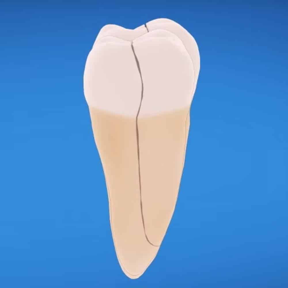 Tooth repair: how to fix a chipped, cracked or broken tooth 14