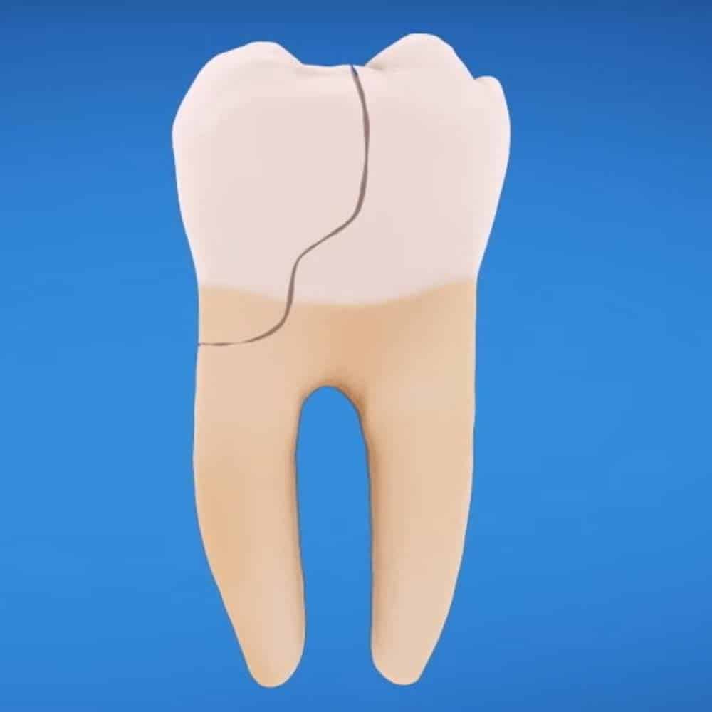 Tooth repair: how to fix a chipped, cracked or broken tooth 13