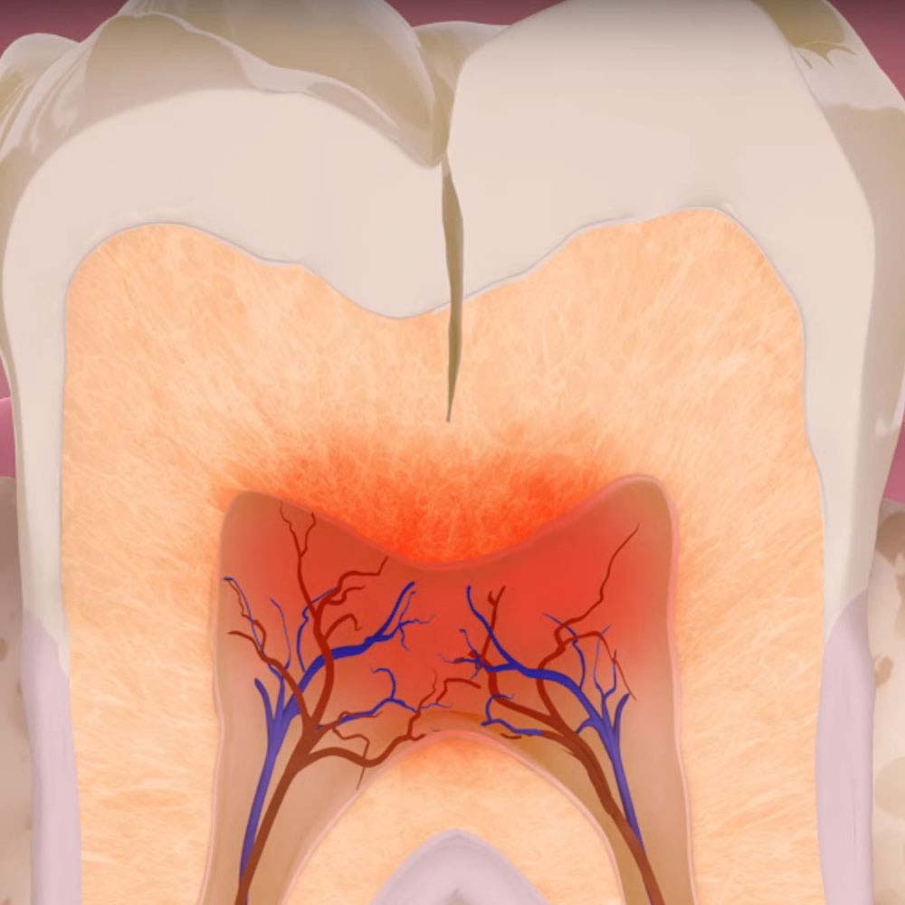 Tooth repair: how to fix a chipped, cracked or broken tooth 24
