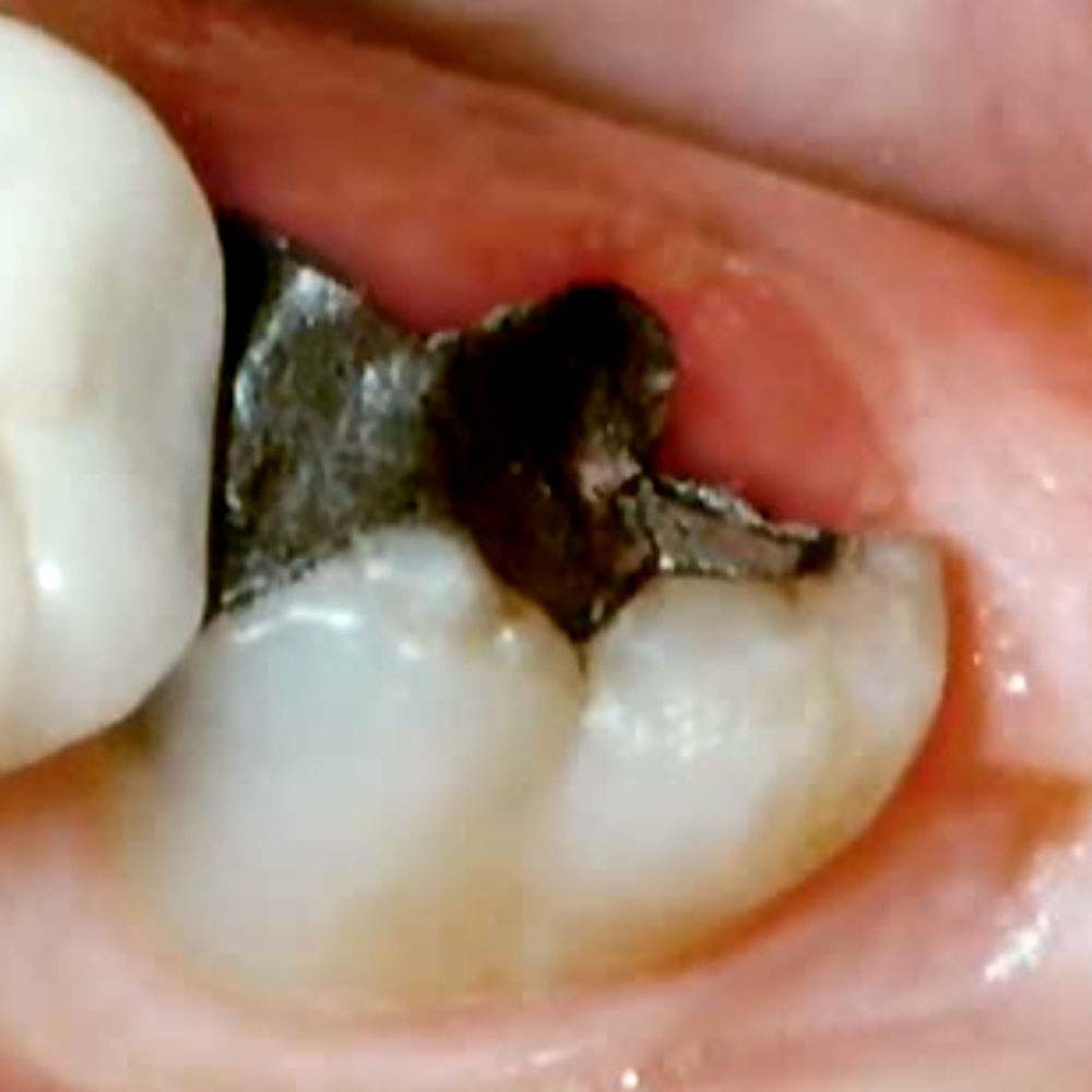 tooth with broken filling