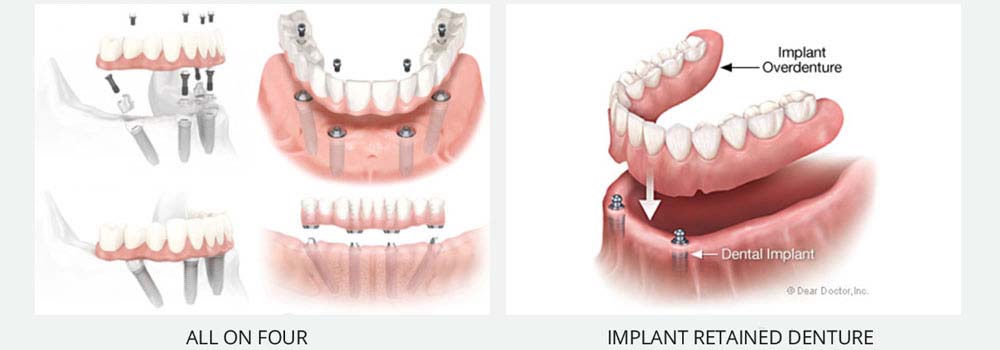 Denture Implants & Implant Retained Dentures: Procedure, Costs & FAQ 11