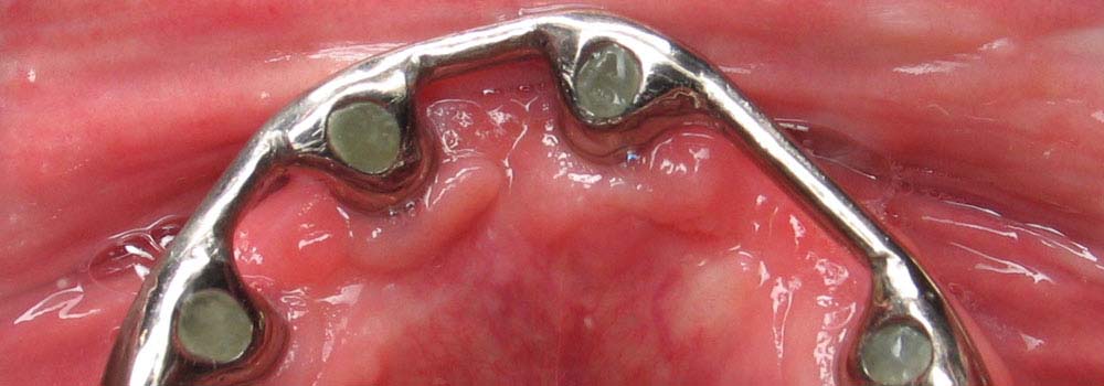Denture Implants & Implant Retained Dentures: Procedure, Costs & FAQ 14