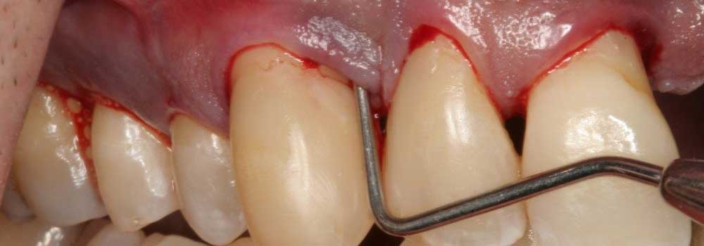 Teeth with bleeding gums