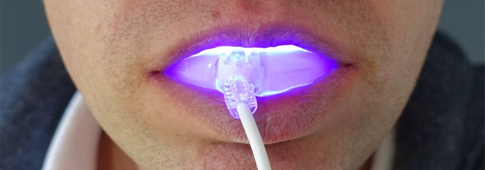 Best Teeth Whitening: Which Kits & Methods Can You Trust? 7