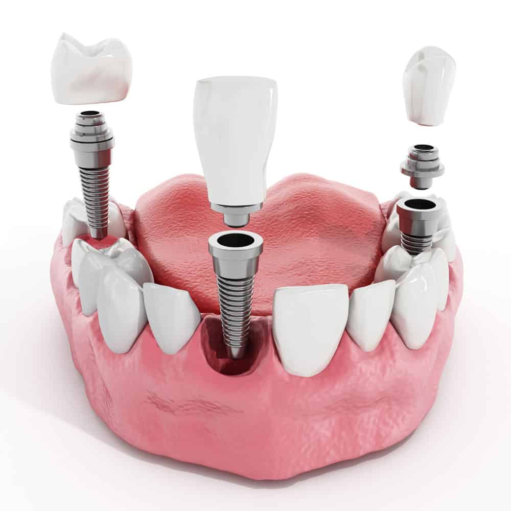 Dental Implants: Costs, Procedure & FAQ (UK) 6