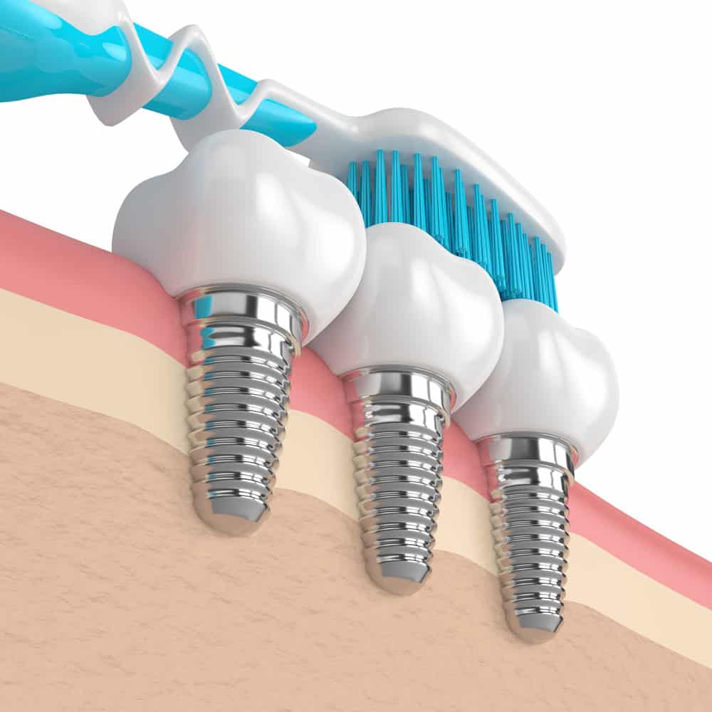 Dental Implants: Costs, Procedure & FAQ (UK) 13