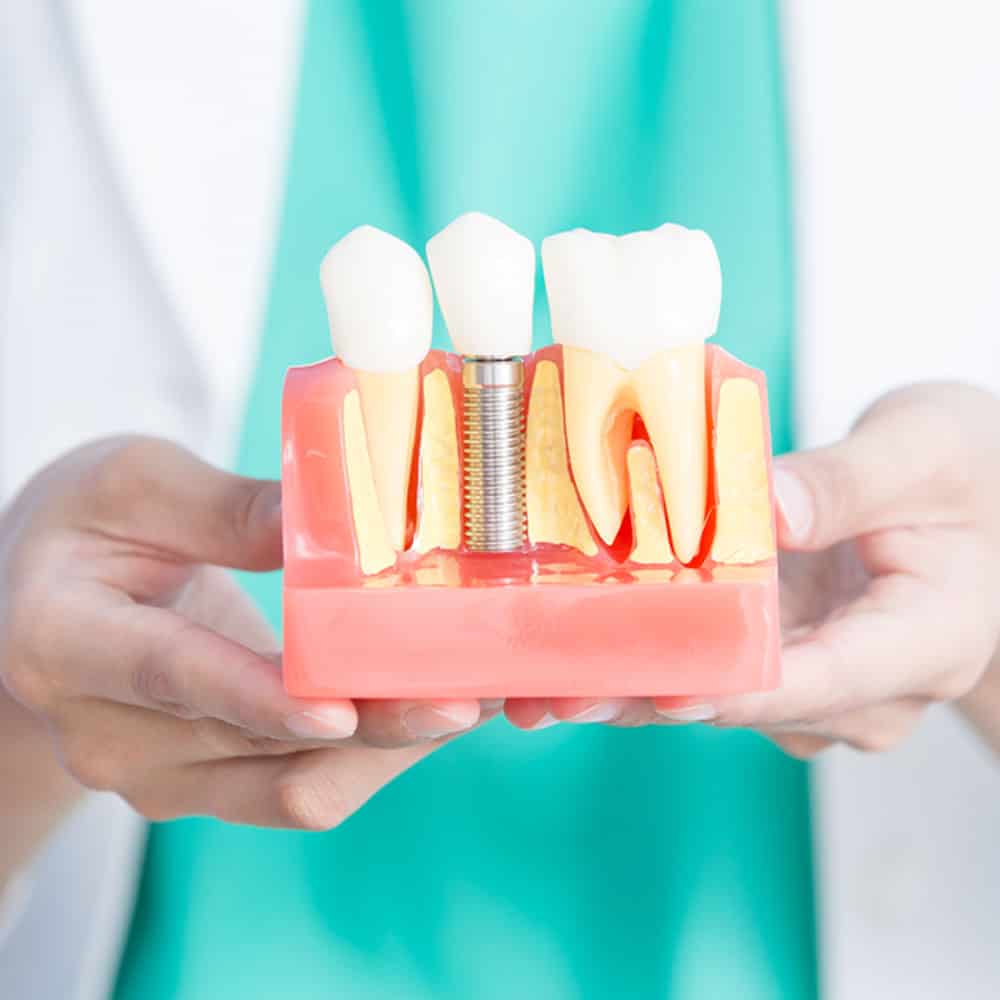 Dental Implants: Costs, Procedure & FAQ (UK) 4
