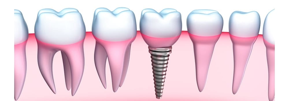 Dental Implants: Costs, Procedure & FAQ (UK) 3