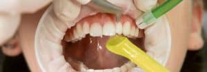 A patient undergoing AirFlow® air polishing dental treatment