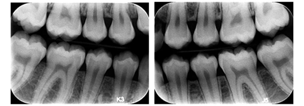 Example of x-rays taken during a dental checkup