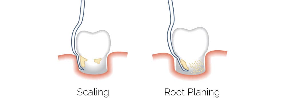 Scaling vs Root Planing
