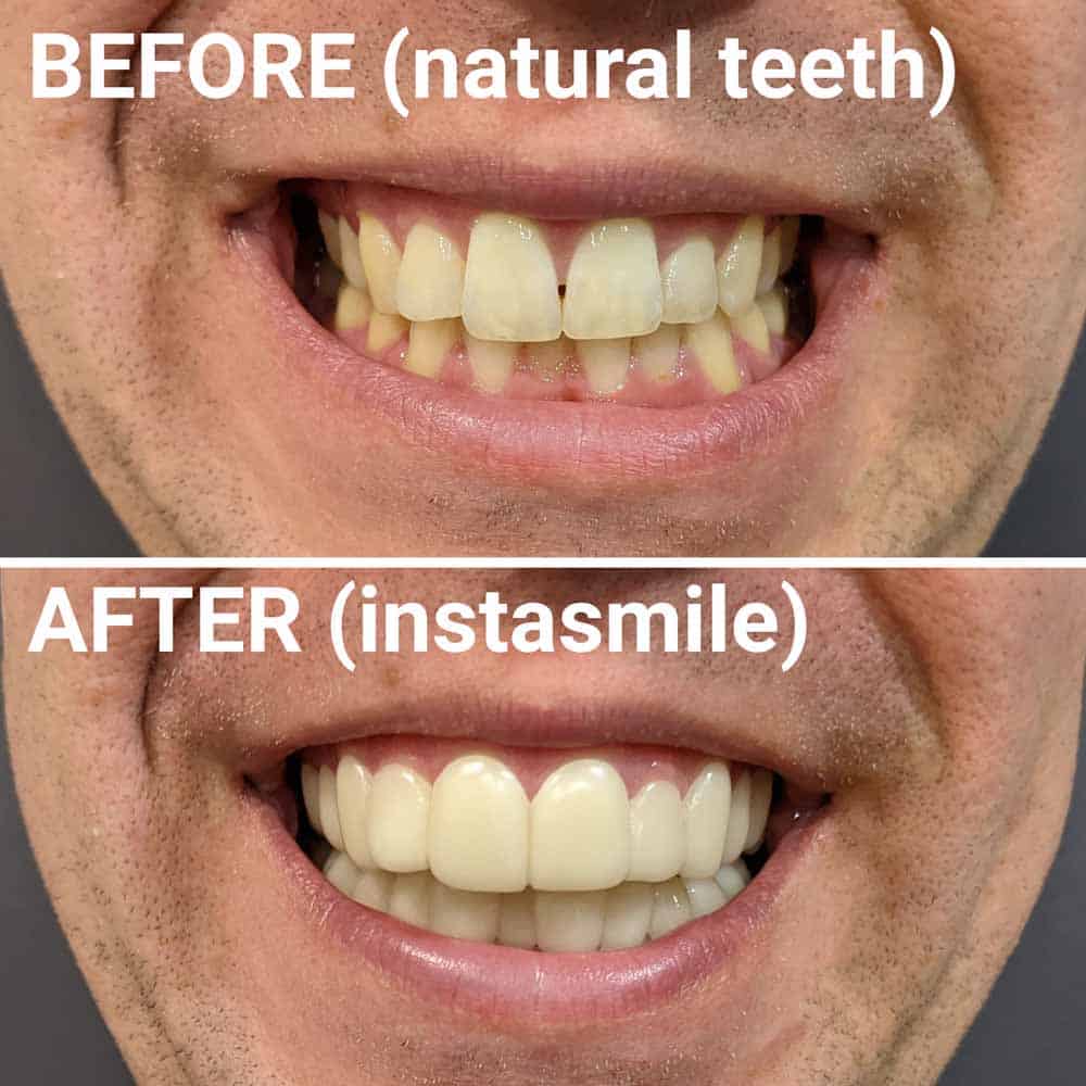 Close up before and after view of front teeth instasmile