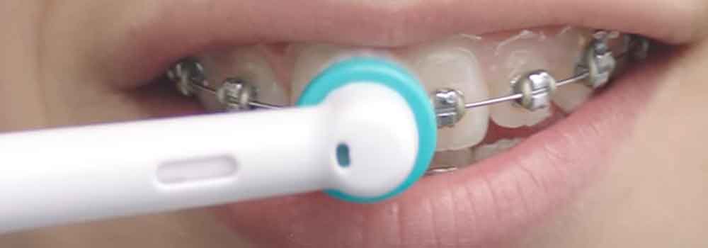 Best electric toothbrush for braces