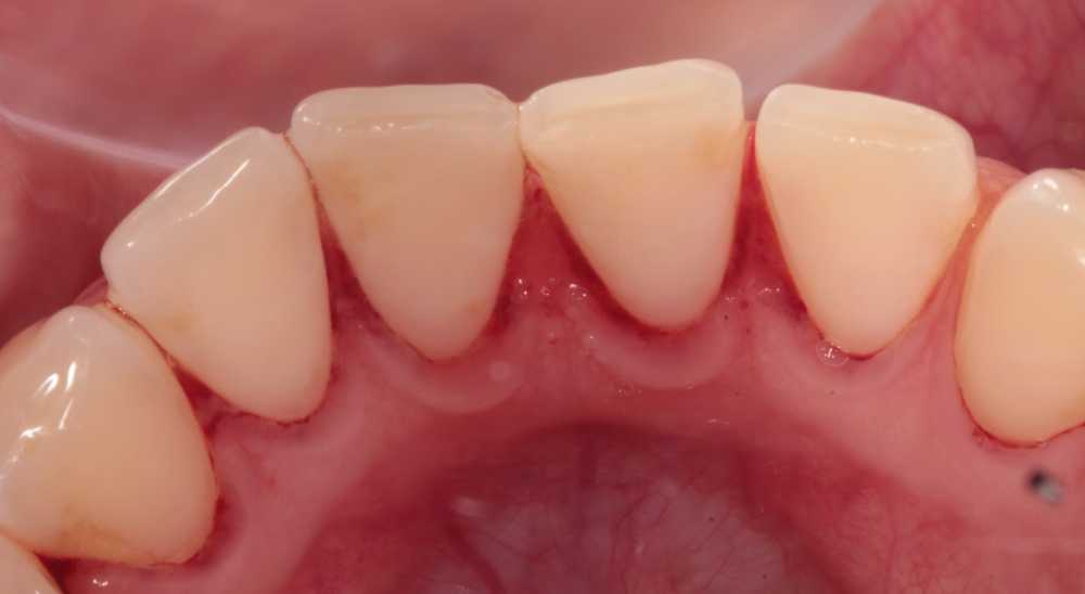 Inside of teeth with some blood on gums