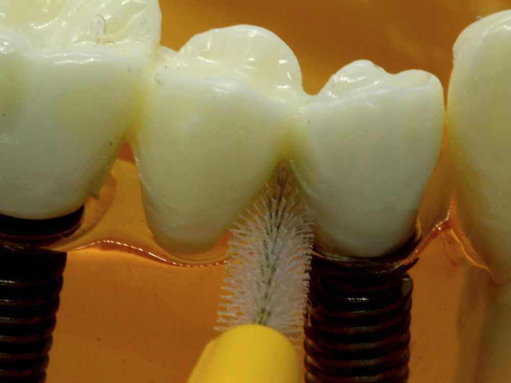 Interdental brush being used on scientific teeth model
