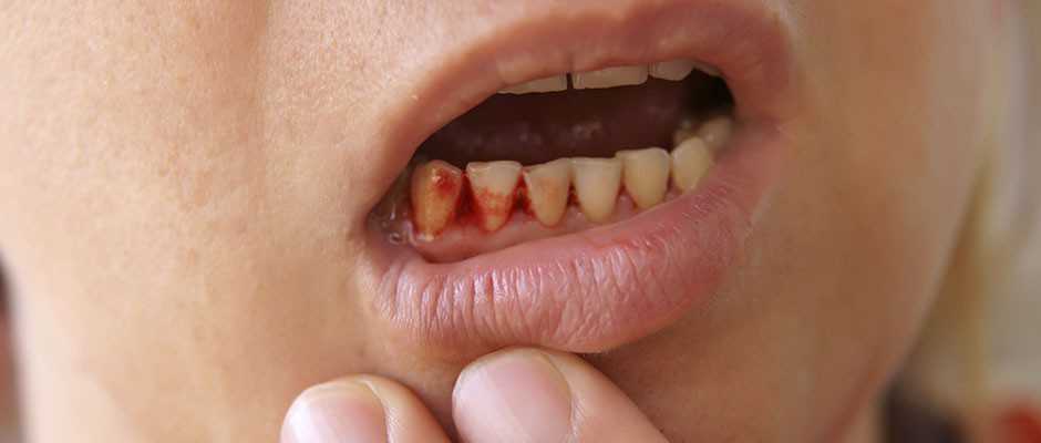 Person pulling lip down to show bleeding gums