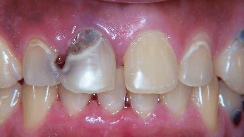Severely decayed front tooth