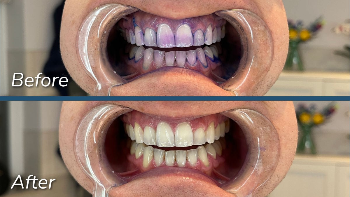 Sonicare Series 5300_plaque disclosing before and after