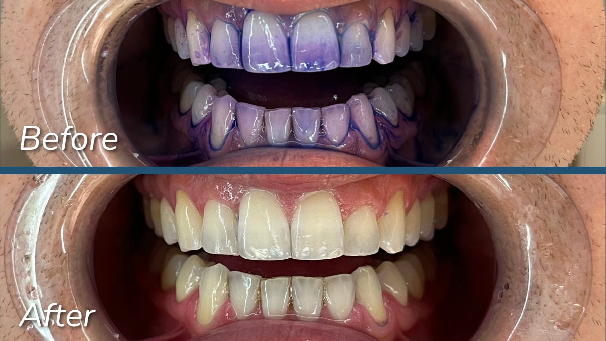 Plaque disclosing before and after template