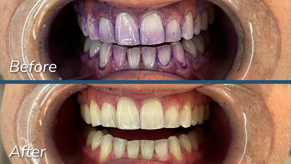 Sonicare Series 6500 plaque disclosing test before and after photo