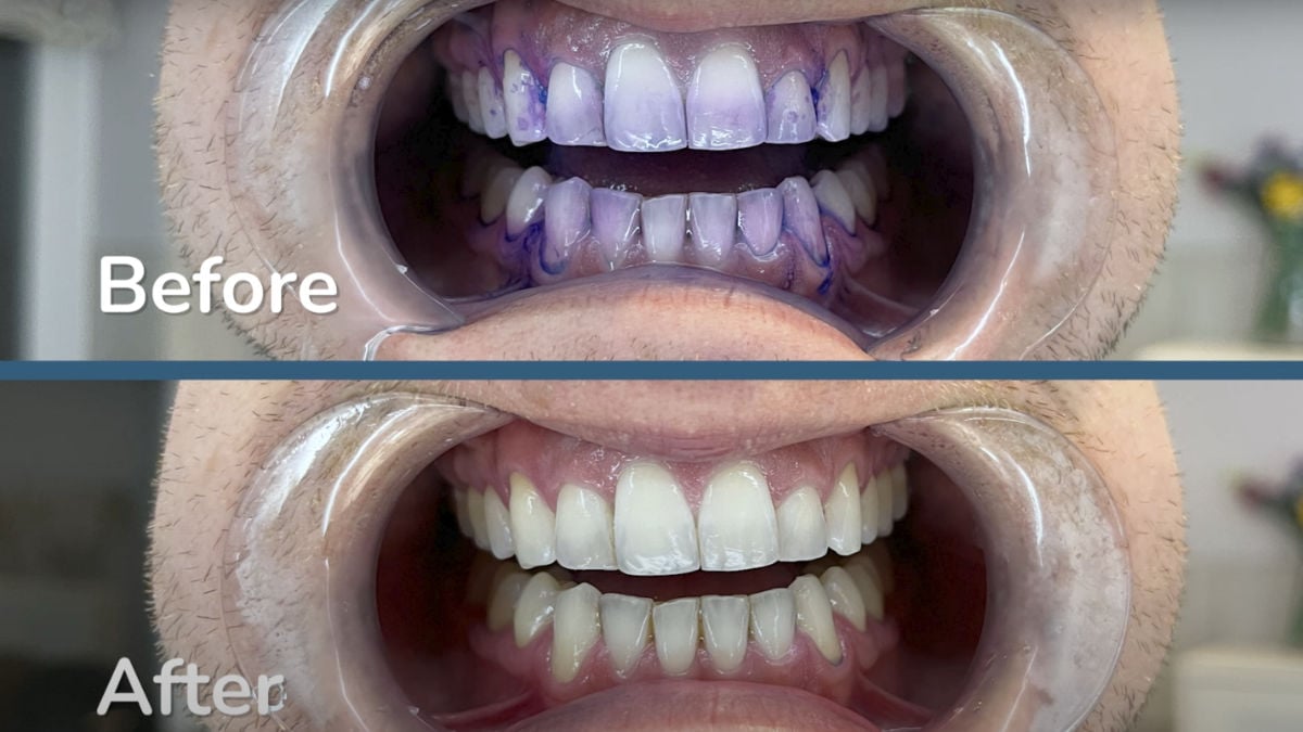 Sonicare Series 7100 plaque disclosing before and after