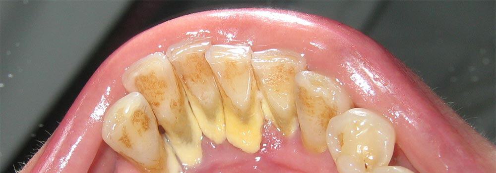 Hardened plaque on the back of teeth