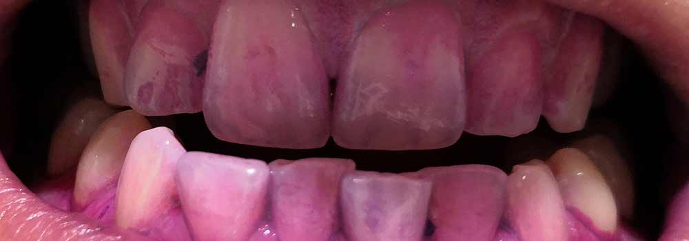 Teeth with plaque disclosing solution on them