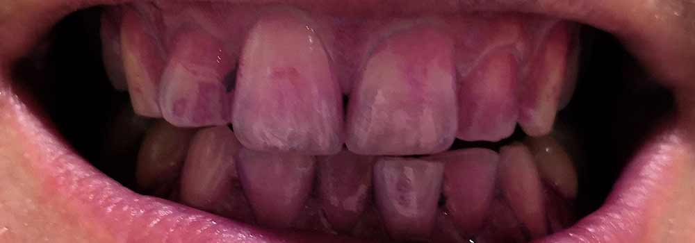 Dye showing plaque on teeth