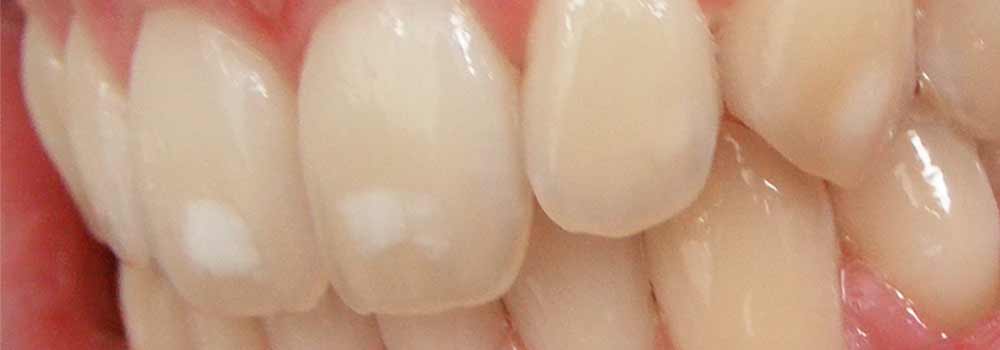 White Spots On Teeth: Why Are They There & How Do You Get Rid Of Them? 1
