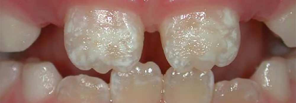 Multiple white marks on teeth
