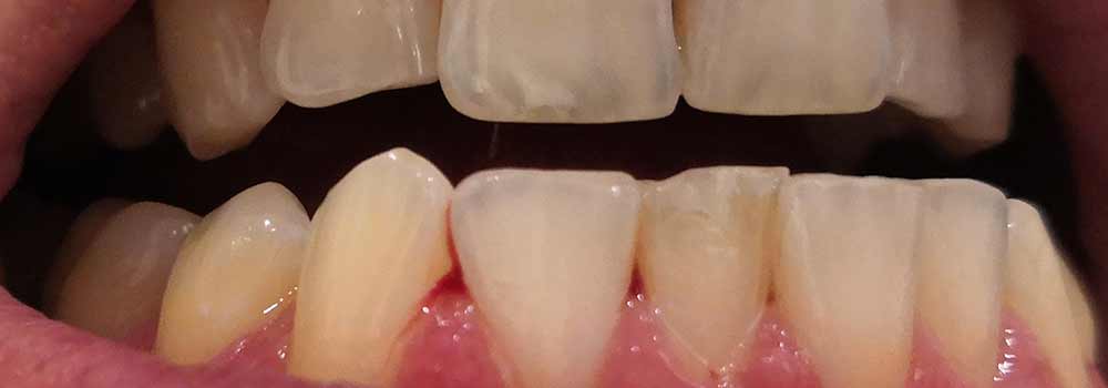 Gum bleeding and visible between teeth