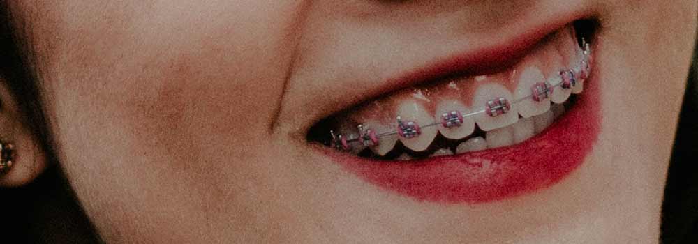 How to brush your teeth with braces 4