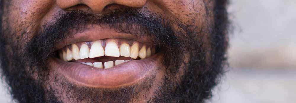 Smile showing teeth of Afro-Caribbean man