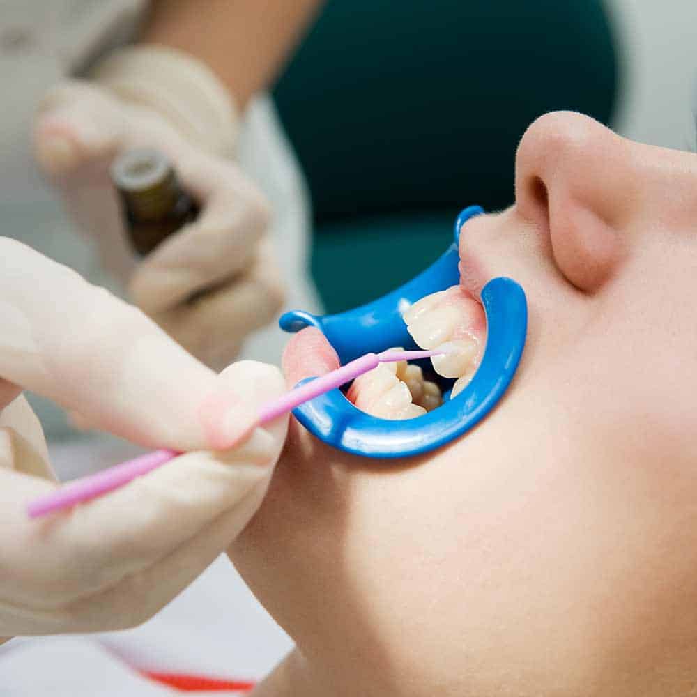 Dental Veneers: Costs, Types, Procedures & FAQ 18