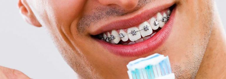 toothpaste for braces stains