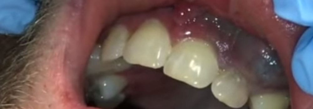 Tooth, mouth & gum abscess treatment: a detailed guide 8