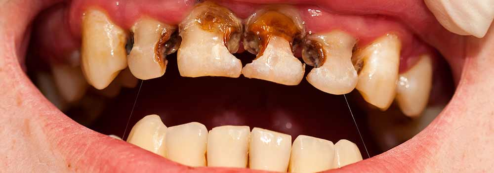 Rotten and decayed teeth