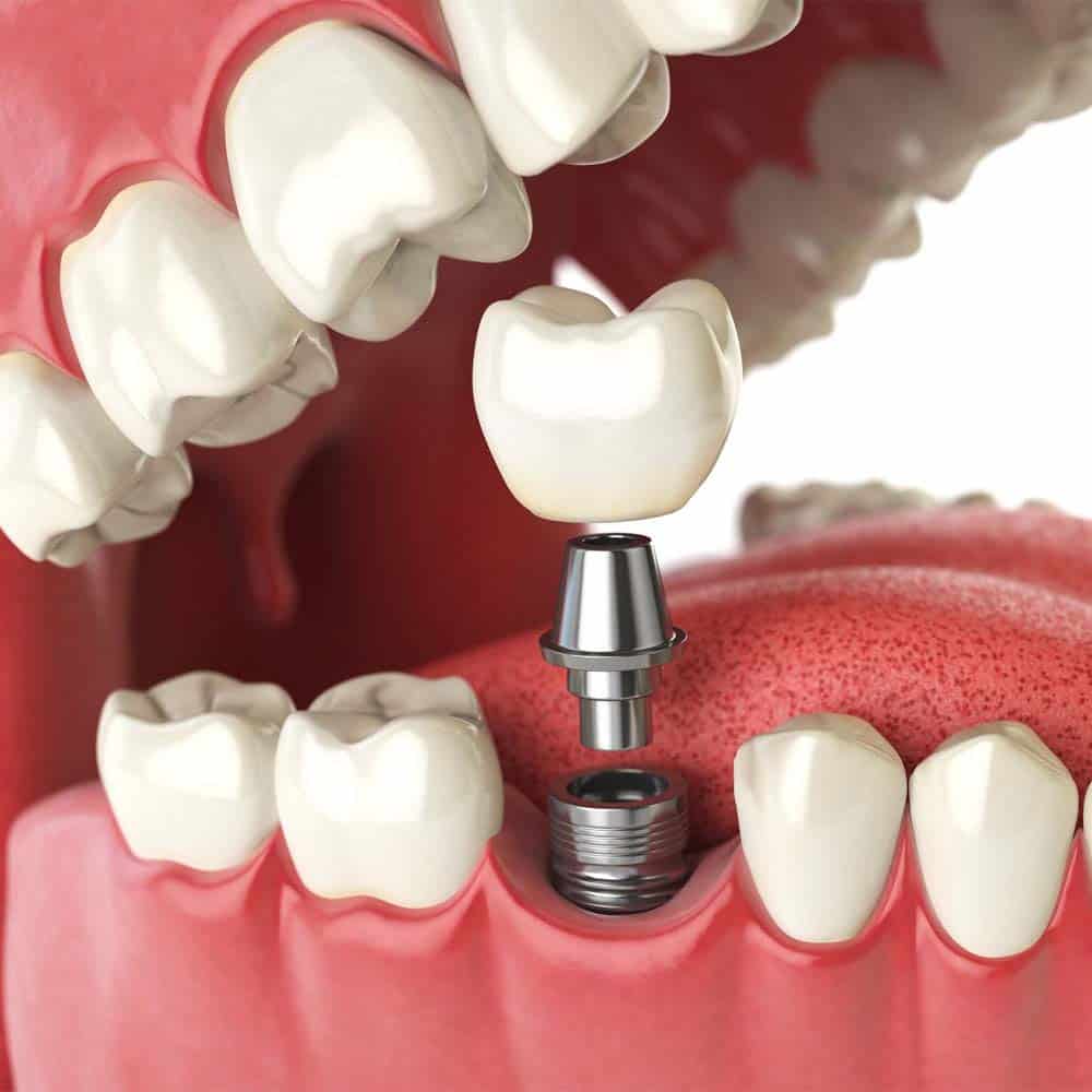 Dental Implants: A Complete Guide To Costs & Procedures 7