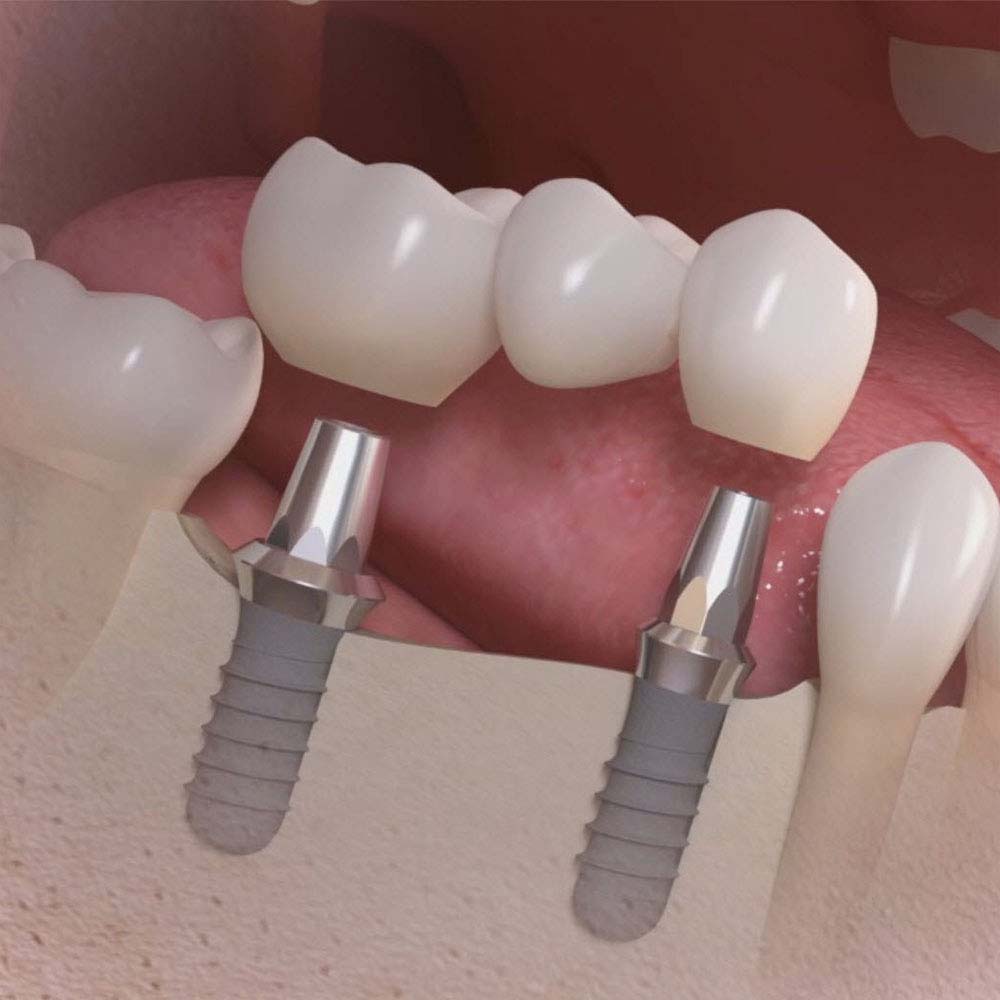 Dental Implants: A Complete Guide To Costs & Procedures 10
