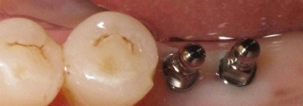 Mini & Midi Dental Implants: Costs, Procedure & FAQ 7