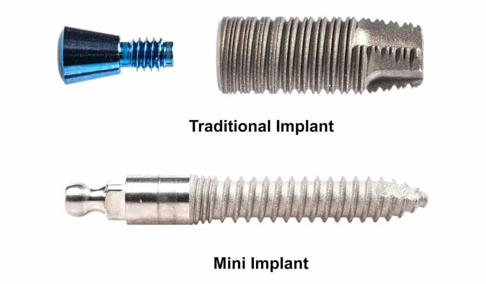 Mini & Midi Dental Implants: Costs, Procedure & FAQ 1