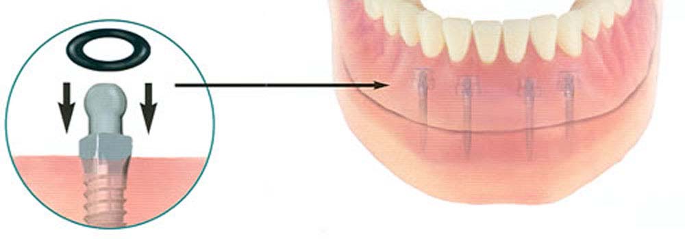 Mini & Midi Dental Implants: Costs, Procedure & FAQ 11