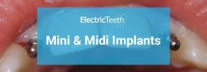 Mini & Midi Dental Implants: Costs, Procedure & FAQ